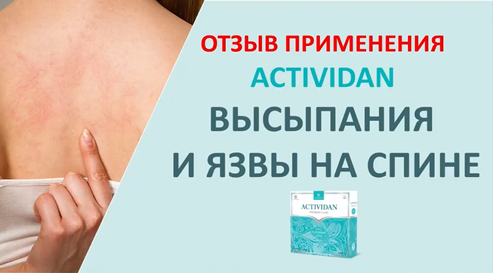 N23 Отзыв применения продукта ACTIVIDAN - ВЫСЫПАНИЯ И ЯЗВЫ НА СПИНЕ