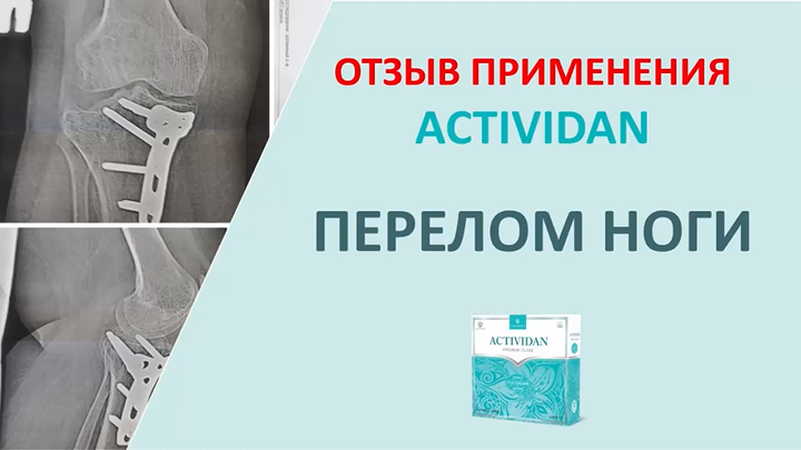 N27 Отзыв применения продукта ACTIVIDAN - ПЕРЕЛОМ НОГИ