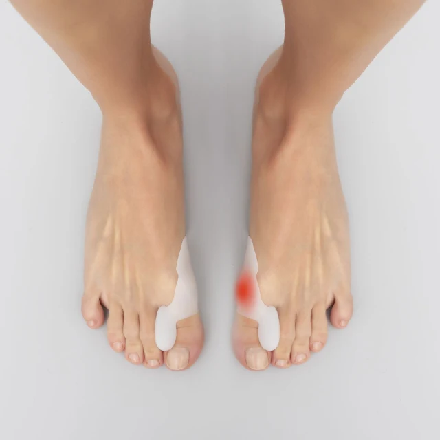 Silicone Bunion Corrector Protector Bunilief 2 Units